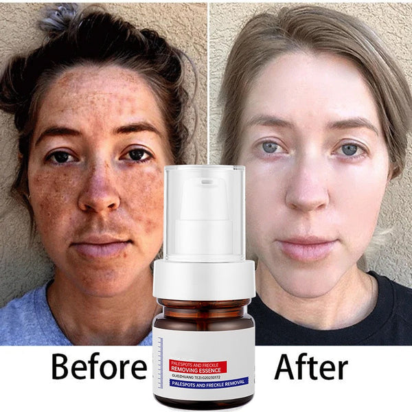 ⚡5-second brightening！Vitamin C Whitening Freckles ESSENCE